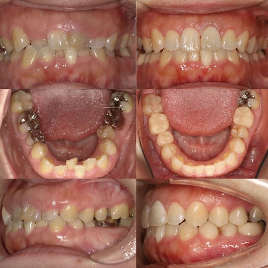 ♡裁断済 虫歯思いの歯科矯正治療 ガタガタ。虫歯。 | 佐賀駅前矯正歯科