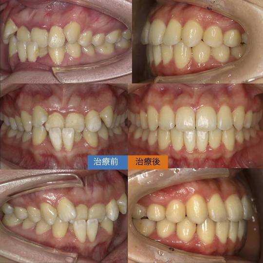 ♡裁断済 虫歯思いの歯科矯正治療 ガタガタ。虫歯。 | 佐賀駅前矯正歯科